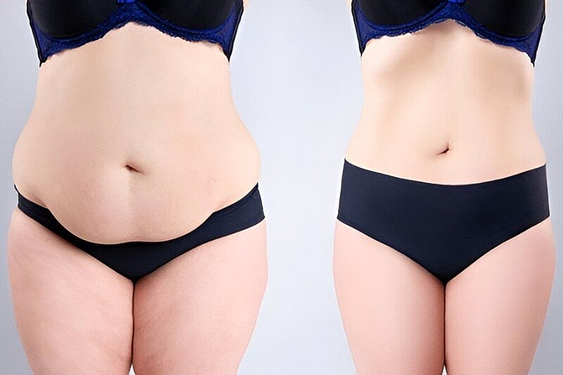 3 Factors to Consider Before Having a Tummy Tuck Procedure in Tampa, Florida