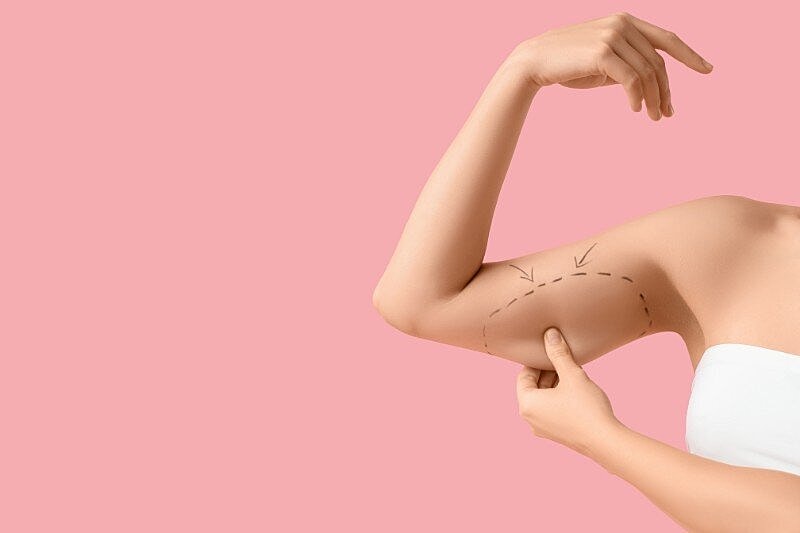 Smoother Arm Lift Recovery and Scar Care – Weekly Brachioplasty Planner