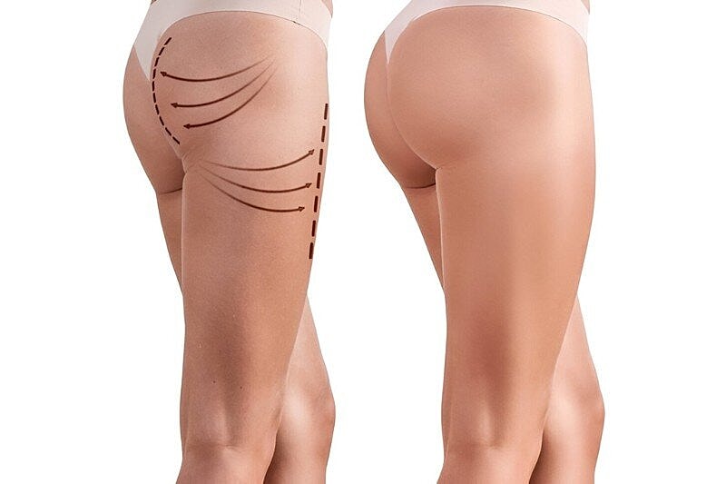 Brazilian Butt Lift vs Traditional Butt Lift: What Is the Difference and Which Is Right for You?
