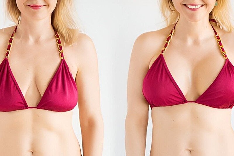 Personalized Breast Augmentation with Implants and Fat Transfer in Tampa, FL