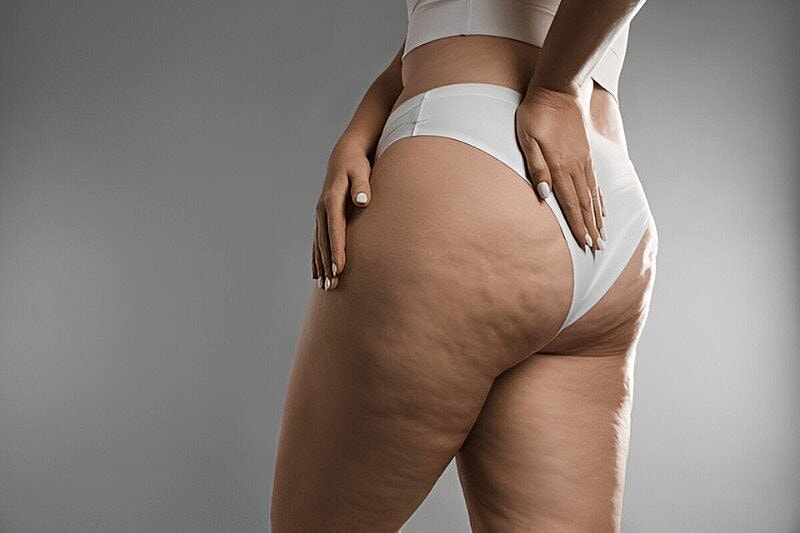 Does Liposuction Get Rid of Cellulite? Facts, and Alternative Treatments Options in Tampa