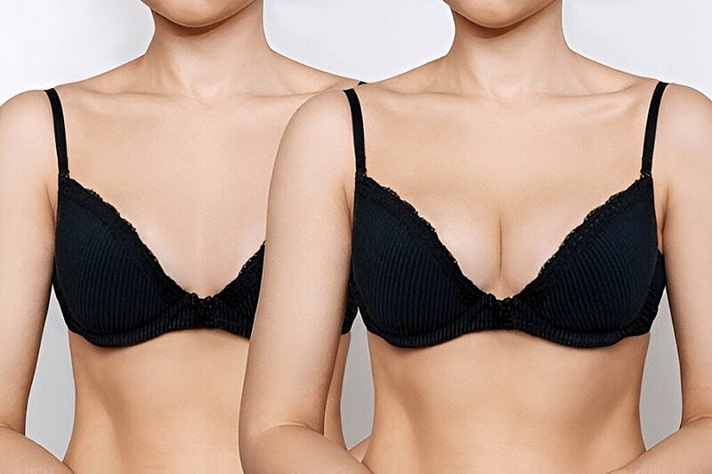Fat Grafting vs. Implants: Which Looks and Feels More Natural? Explore Safe Options