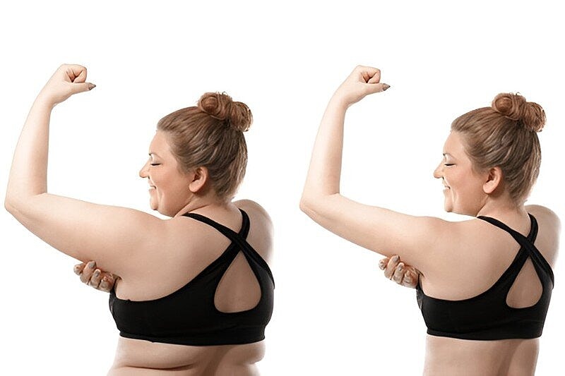 Go Sleeveless with an Arm Lift Brachioplasty – Refine Arm Contour with Certified Care