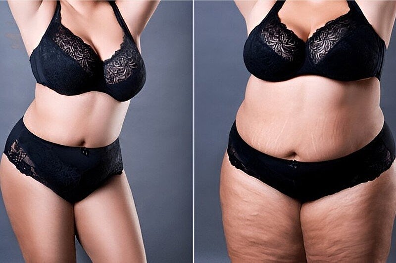 How Long Does It Take to See Final Results After a Tummy Tuck in Tampa, FL?