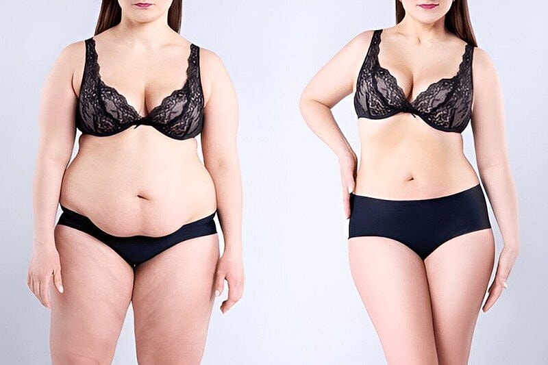 How to Manage Scarring After a Tummy Tuck? Post-Surgery Care Guide Tips in Tampa, FL