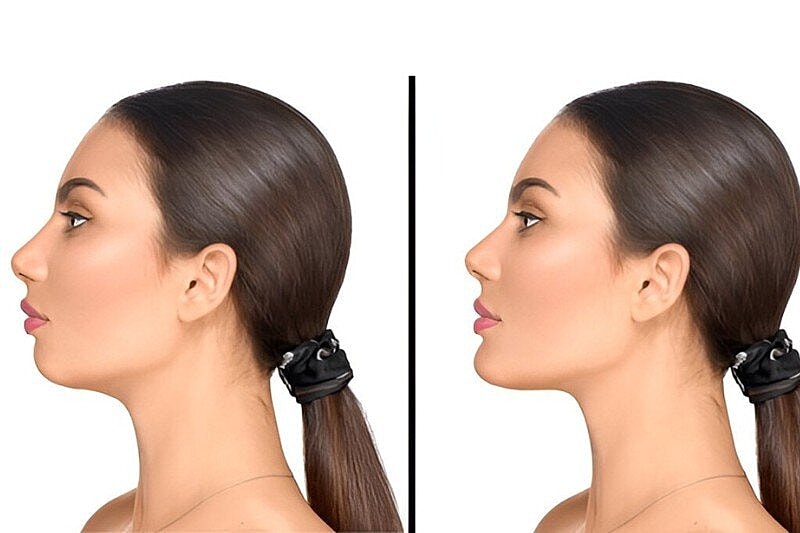 Improving Your Facial Contour With a Chin Implant Surgery – Restore Facial Harmony