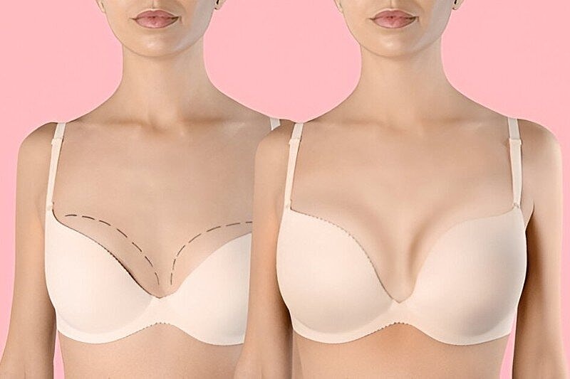 Is Breast Augmentation Right for You? Key Questions to Ask Yourself Before Consultation