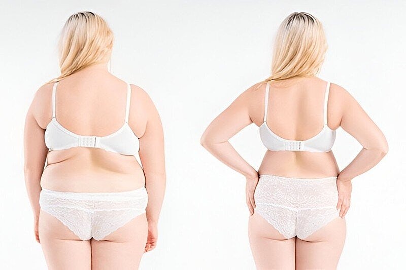 Laser Smart Lipo Treatment – Precision Fat Reduction and Body Contouring in Tampa, FL