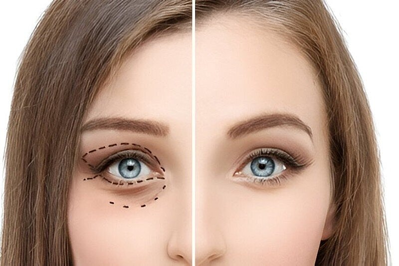Ptosis Droopy Eyelid Surgery – Blepharoplasty for Saggy Eyelids for Youthful Eyes