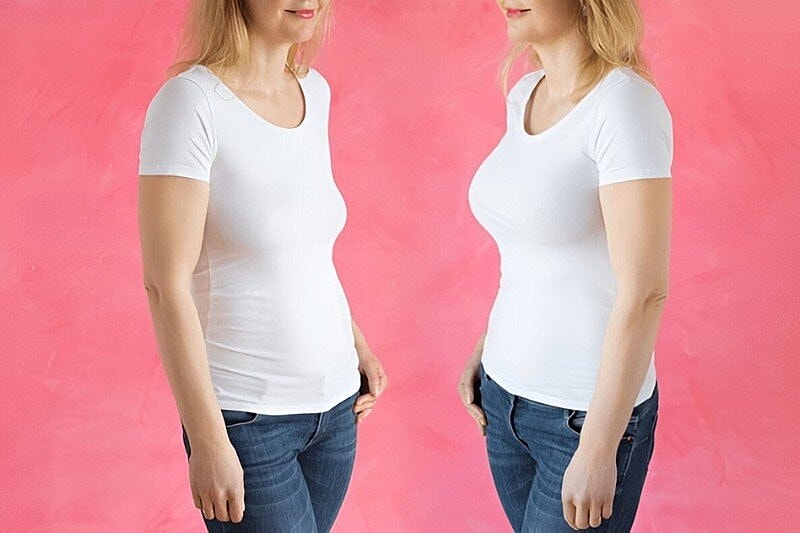 Benefits of Breast Lift Surgery After Weight Loss – Board-Certified Care in Tampa
