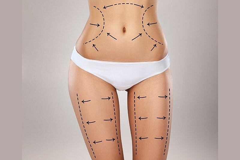 What Are the Different Types of Liposuction? Compare and Find the Right Treatment Option