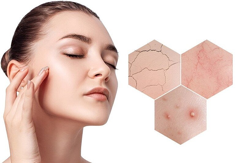 What Is a Chemical Peel and How Does It Help? Professional Skin Exfoliation Treatment
