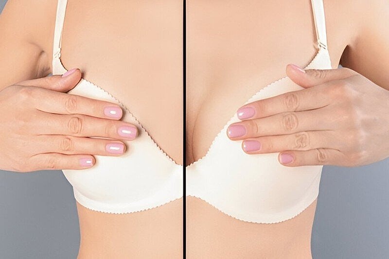 What to Expect During Breast Lift Recovery? Healing Stages, Timeline, and Aftercare Tips
