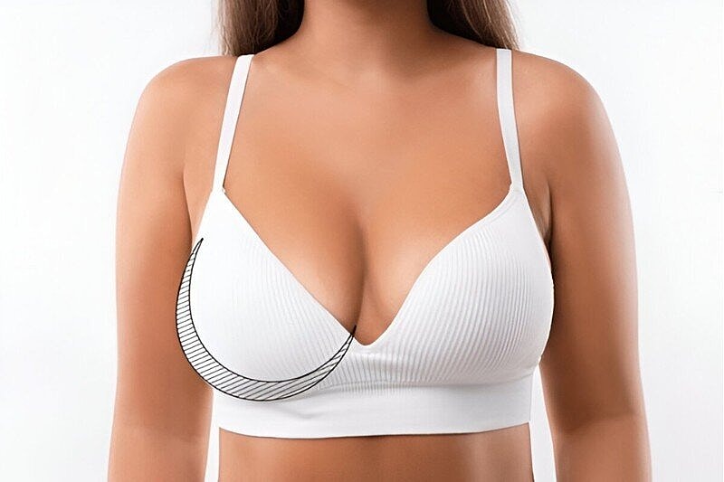 When Is Breast Reduction Surgery Necessary? Signs, Considerations, and Candidacy