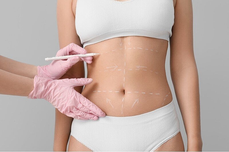 Which Type of Liposuction Is the Best for My Goals? Compare Available Options