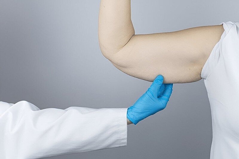 Why Consider Getting an Upper Arm Lift? Brachioplasty Procedure Benefits