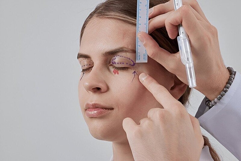 Will People Notice My Blepharoplasty? Tampa Insights by Dr. Castor for Natural Results