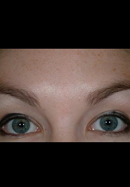 Botox Before & After