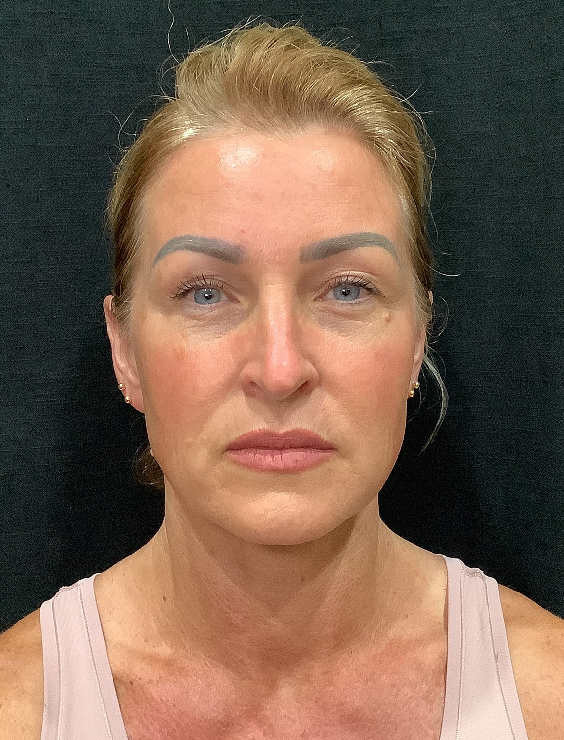 Facelift Before & After