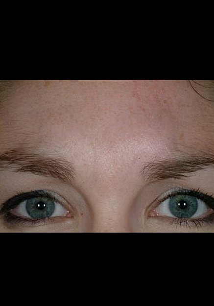 Browlift Before & After