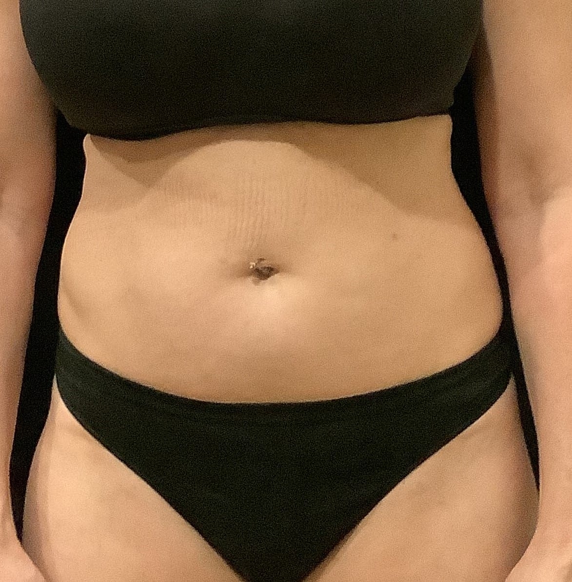 Tummy Tuck Before & After