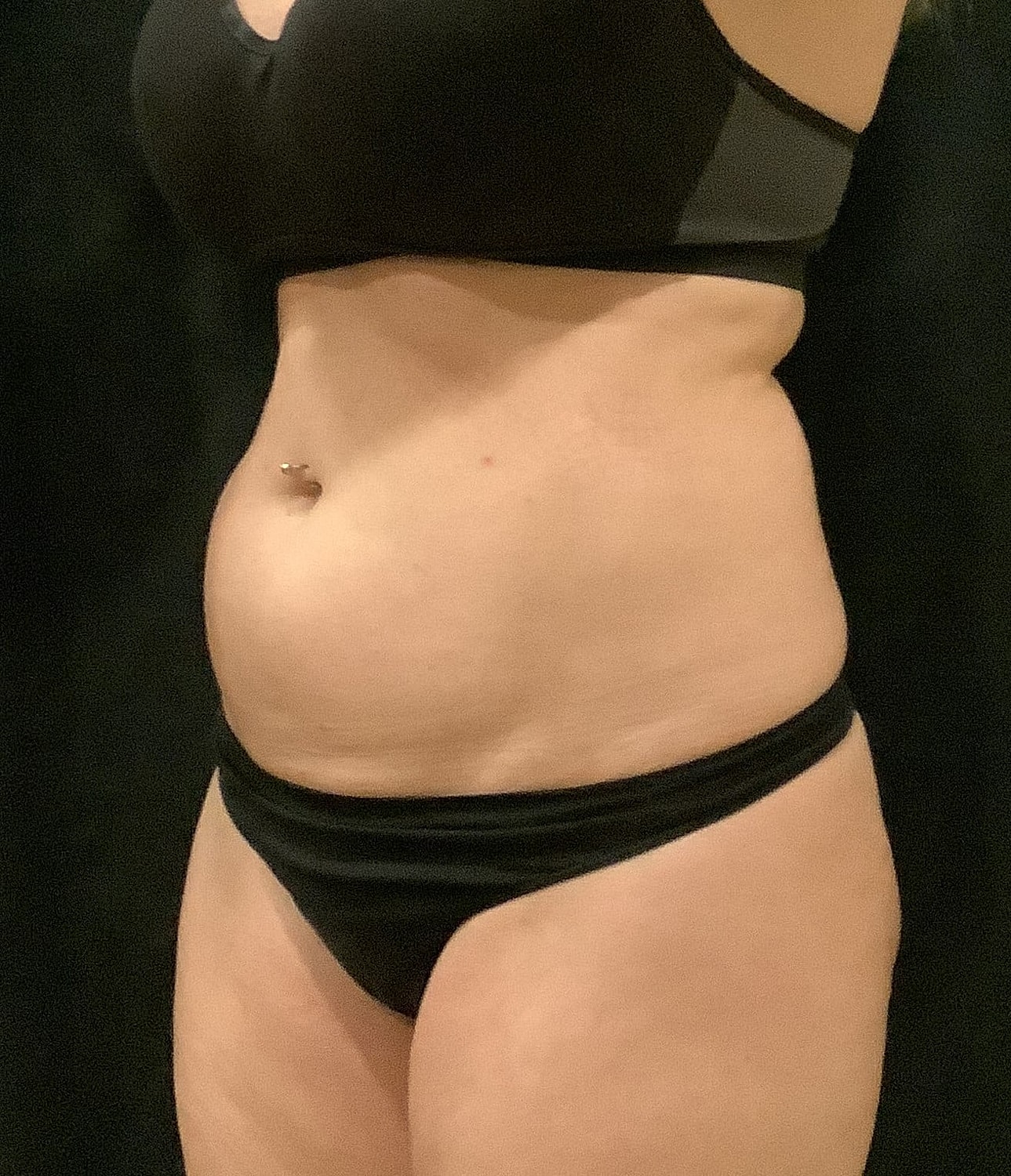 Tummy Tuck Before & After