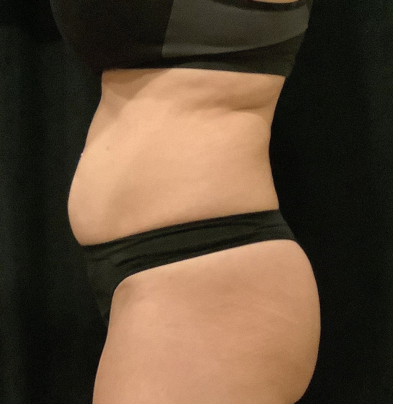Tummy Tuck Before & After