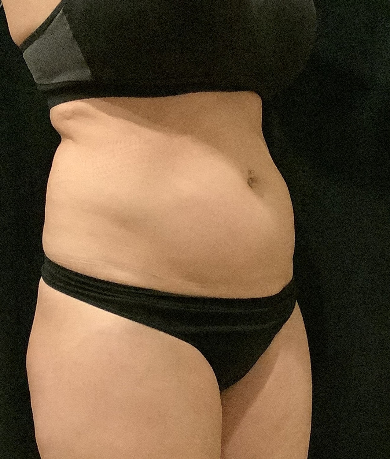 Tummy Tuck Before & After