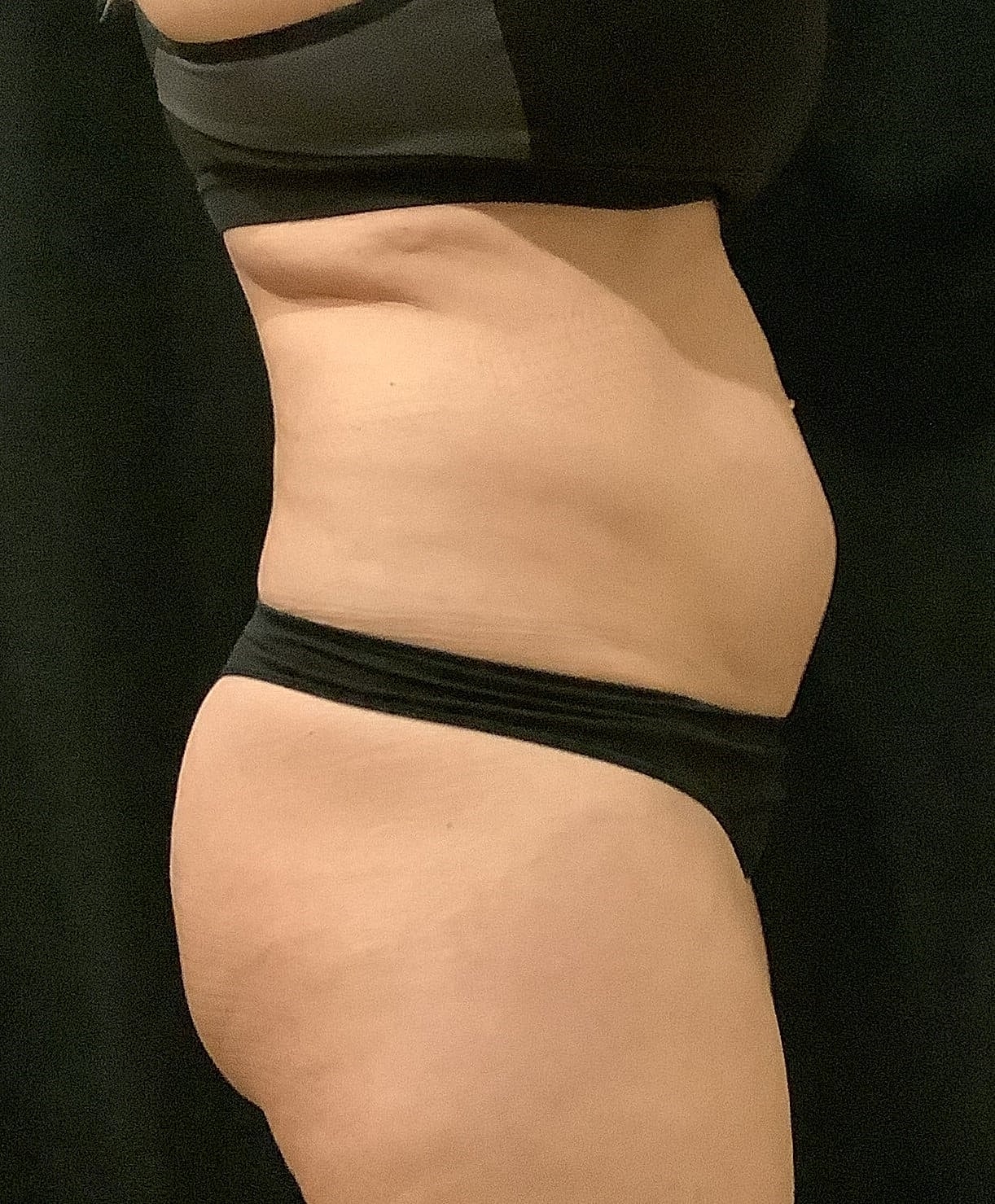 Tummy Tuck Before & After