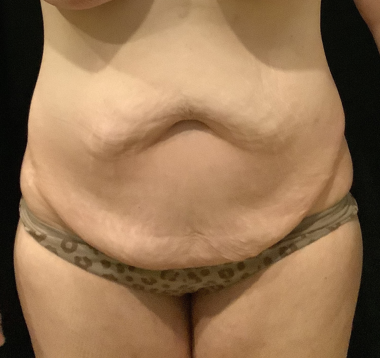 Tummy Tuck Before & After