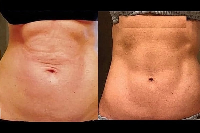 Comparison of abdominal skin before and after treatment.